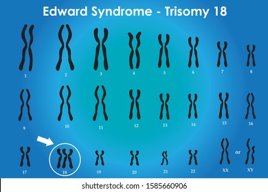 Edwards Syndrome Images Stock Photos Vectors Shutterstock