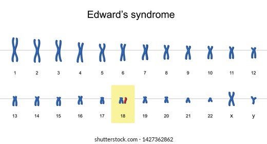 Edward's Syndrome Karyotype, Autosomal Abnormalities, Trisomy 18