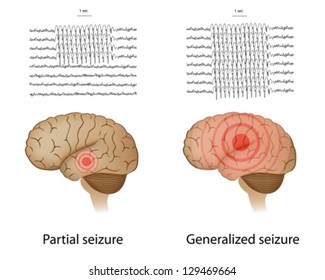 EEG In Partial And Generalized Epilepsy