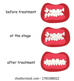 The effect of braces is a visual demonstration by an orthodontist before the procedure, during treatment and after the procedure is completed. Stock vector illustration isolated on white background.