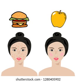 Effect of diet on the skin. Skin with acne.  Junk food. Foods for Healthy Skin. Vector illustration. 
