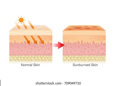 Effect of sunlight cause sunburned skin. Illustration about danger of UV rays.