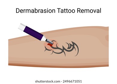 Procedimiento efectivo de eliminación de tatuajes de dermoabrasión