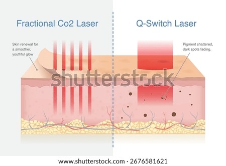 Effects of Fractional CO2 Laser vs Q Switch Laser on Skin Layers. Fractional CO2 laser resurfaces skin, promoting renewal for smoother, youthful glow. Q Switch laser shatters pigment, fading dark spot