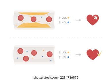 Effects of good HDL and bad LDL cholesterol on heart health. Infographic vector with cross section of arteries with lipoproteins, plaque fat and erythrocytes