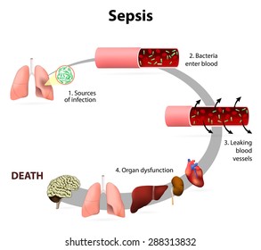  Effects of sepsis. Presence of numerous bacteria in the blood, causes the body to respond in organ dysfunction.