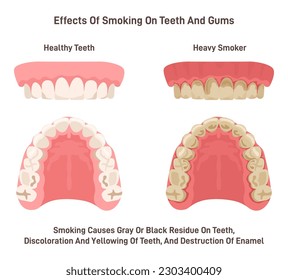 Effects of smoking on teeth and gums. Oral cavity of heavy smoker compared to non-smoker. Dental care and health. No Tobacco campaign. Flat vector illustration