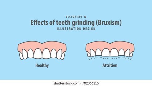 Effects of teeth grinding (Bruxism) illustration vector on blue background. Dental illustration.