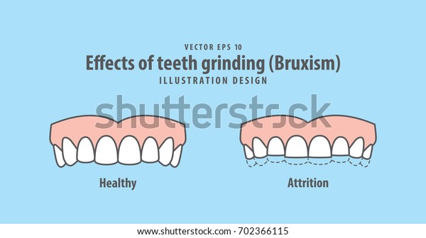 Effects of teeth grinding (Bruxism)
illustration vector on blue background. Dental
illustration.
