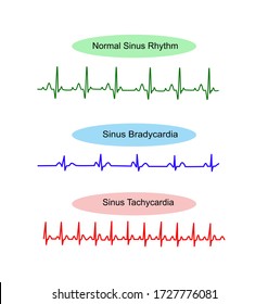 EGC Pattern Vector Is Normal Sinus Rhythm Rate 60-100bpm., Sinus Bradycardia Rate Less 60 Bpm.and Sinus Tachycardia More Than Rate 100bpm.