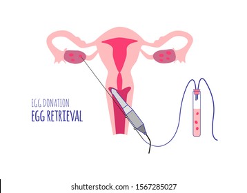 Egg Retrieval. Egg Donation. Donor. In Vitro Fertilization. Vector Illustration.