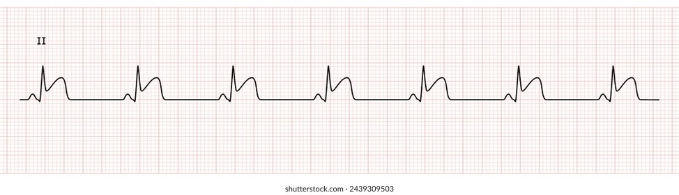 EKG Monitor in lead II Showing  Sinus Rhythm with STEMI at Inferior Wall