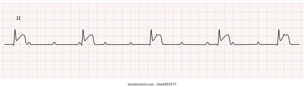 Monitor EKG en derivación II que muestra bloqueo cardíaco completo con IMEST en la pared inferior