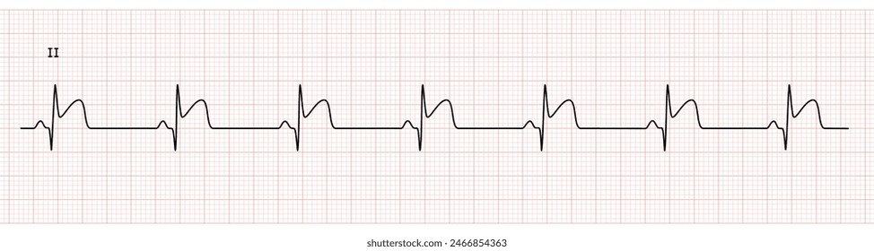 EKG Monitor in lead II Showing  Sinus Rhythm with Late STEMI at Inferior Wall with Deep Q Wave