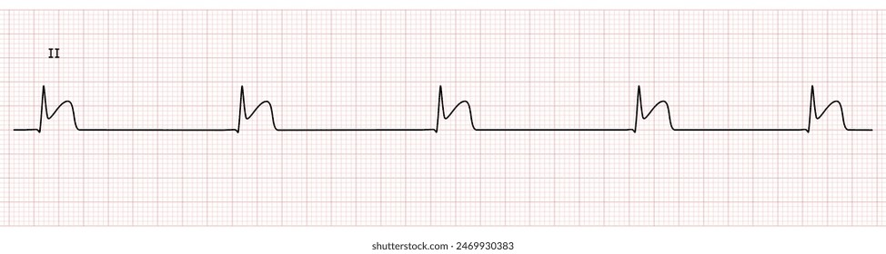 EKG Monitor in lead II Showing  junctional Bradycardia with STEMI at Inferior Wall