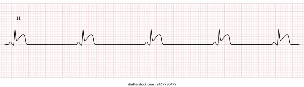 EKG Monitor in lead II Showing  Sinus Bradycardia with STEMI at Inferior Wall