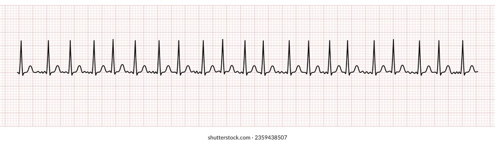 EKG Monitor Showing Atrial Fibrillation With Rapid Ventricular Response