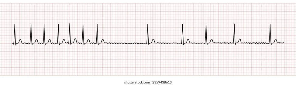 EKG Monitor Showing Atrial Fibrillation With Rapid Ventricular Response and Slower Rate After Adenosine Intravenous