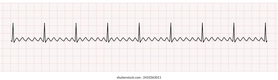 EKG Monitor Showing  Atrial Flutter