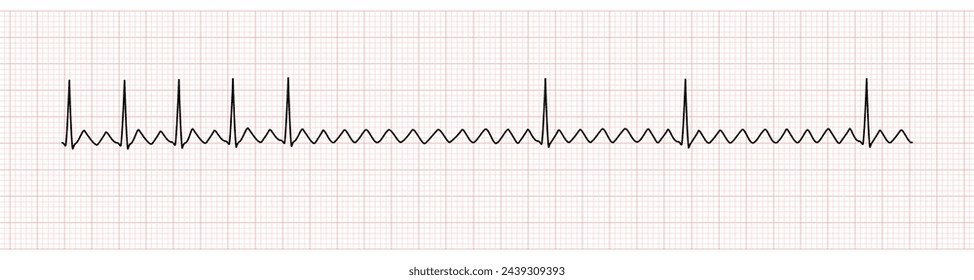 EKG Monitor Showing  Atrial Flutter with 2:1 AV Block After Adenosine Intravenous