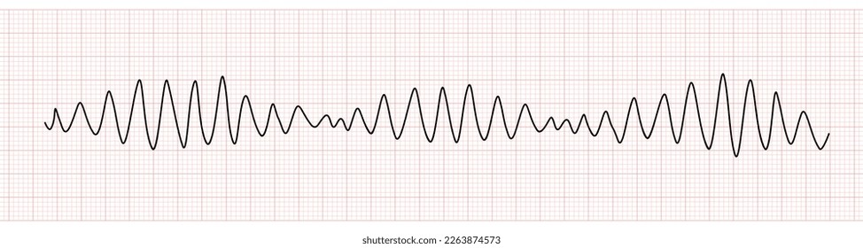 EKG Monitor Showing Polymorphic Ventricular tachycardia or VT: Torsades de pointes