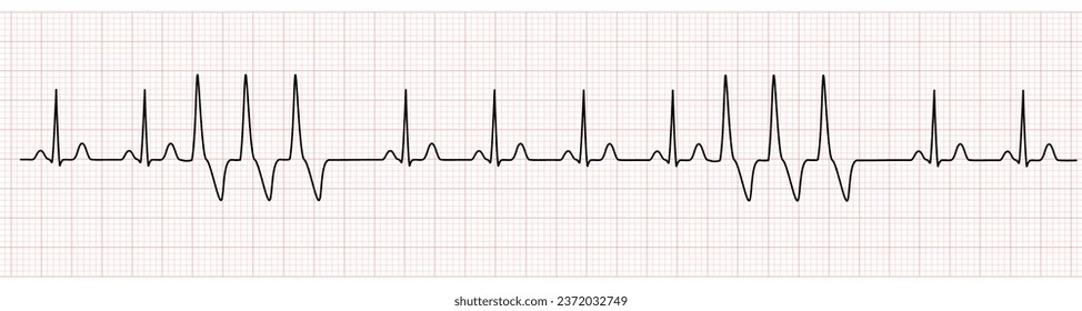 EKG Monitor Showing  Sinus Rhythm with Short Run VT