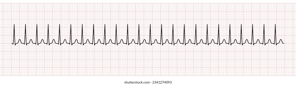 EKG Monitor Showing  Supraventricular Tachycardia