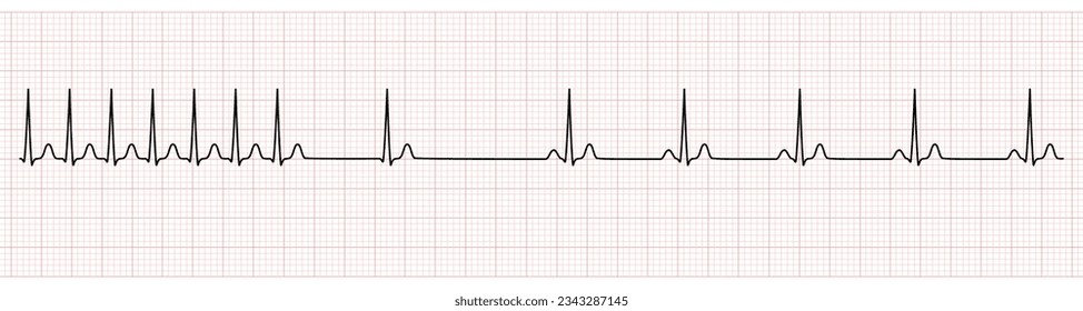 EKG Monitor Showing  Supraventricular Tachycardia Change to Sinus Rhythm After Adenosine Injection