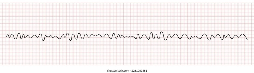 EKG Monitor Showing Ventricular Fibrillation or VF