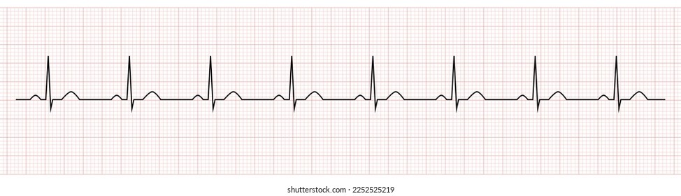 EKG showing normal sinus rhythm of patient 