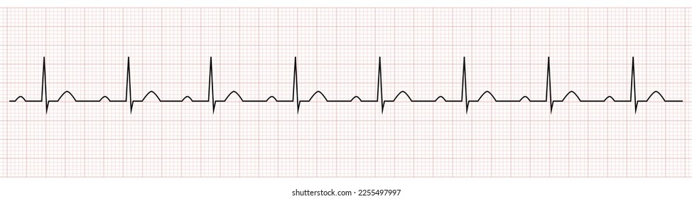 EKG Showing PR prolong which is Sign of First degree AV Block