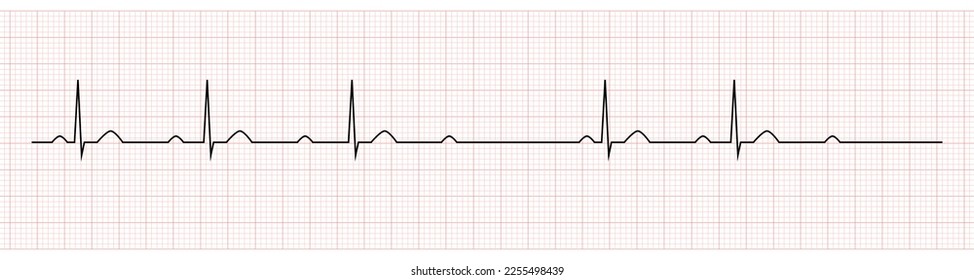 EKG Showing second degree av block mobitz I