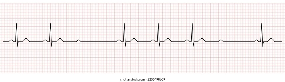 EKG Muestra bloqueo av de segundo grado mobitz II