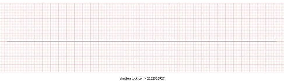 EKG Showing Sinus Bradycardia with Arrest of Patient 