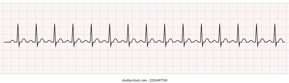 EKG Showing Sinus tachycardia of Patient 