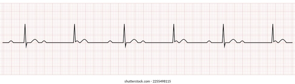 EKG Showing third degree or complete av block