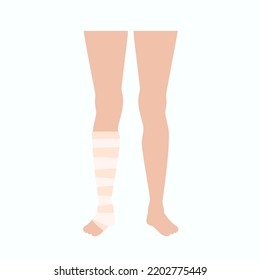 Elastic bandage on human leg. Roll and wrap medical gauze over a foot. Broken or injured ankle. Healthcare concept. First help in a clinic or hospital. Patient with trauma flat vector illustration