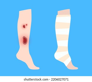 Elastic Bandage On Human Leg. Roll And Wrap Medical Gauze Over A Foot. Broken Or Injured Ankle. Healthcare Concept. First Help In A Clinic Or Hospital. Patient With Trauma Flat Vector Illustration