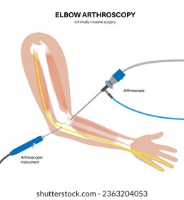 Cirugía mínimamente invasiva en la articulación del codo. Procedimiento médico de artroscopía. Anatomía de humero, úlna y huesos del radio. Dolor de brazo, fractura, osteoartritis o artritis reumatoide x ilustración vectorial de rayos X