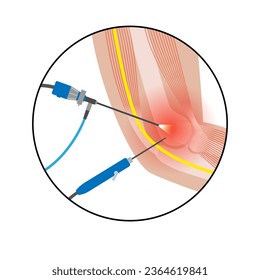 Elbow joint minimally invasive surgery. Arthroscopy medical procedure. Anatomy of humerus, ulna and radius bones. Arm pain, fracture, osteoarthritis or rheumatoid arthritis x ray vector illustration