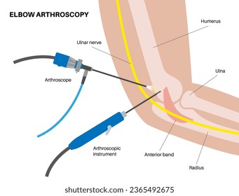 Elbow joint minimally invasive surgery. Arthroscopy medical procedure. Anatomy of humerus, ulna and radius bones. Arm pain, fracture, osteoarthritis or rheumatoid arthritis x ray vector illustration