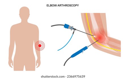 Elbow joint minimally invasive surgery. Arthroscopy medical procedure. Anatomy of humerus, ulna and radius bones. Arm pain, fracture, osteoarthritis or rheumatoid arthritis x ray vector illustration