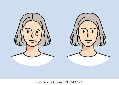 Elderly Woman Portrait Before And After Facial Nerve Palsy. Old Female Suffer From Face Muscle Weakness Or Paralysis. Neurological Disorder Concept. Vector Illustration. 
