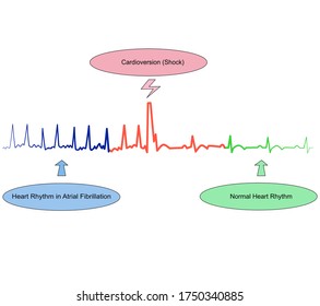 Electrical Cardioversion (Shock) Change An Abnormal Heart Rhythm Back To Normal Heart Rhythm