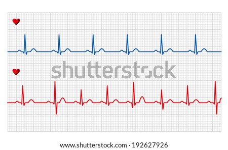 Electrocardiogram 