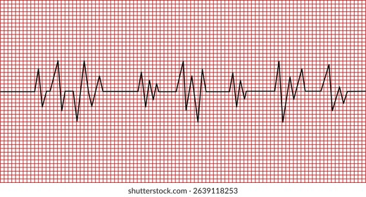 Electrocardiogram  ECG , EKG  of Ischemic Heart Disease Myocardial Infartion 