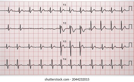 Electrocardiogram, ECG, heartbeat in vector format