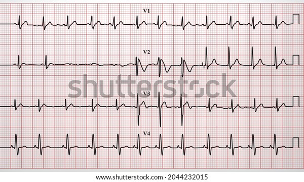 Electrocardiogram Ecg Heartbeat Vector Format Stock Vector (royalty 