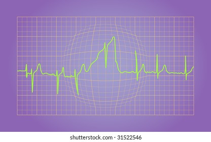 Electrocardiogram of a Healthy Heart
