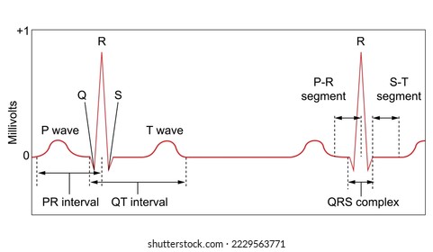 Electrocardiograma: Un seguimiento normal muestra la onda P, el complejo QRS y la onda T y los intervalos PR, QT, QRS y ST indicados, más los segmentos P-R y S-T